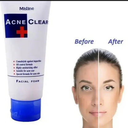 Mistine Acne Clear Facial Foam 85ml